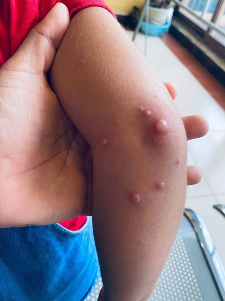 Registran 144 casos de enfermedad Coxsackie